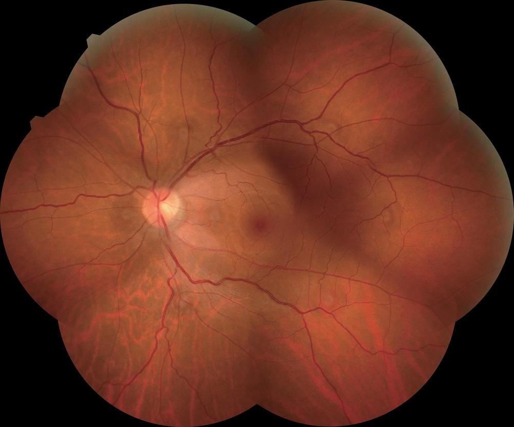 Rétinopathie Diabétique